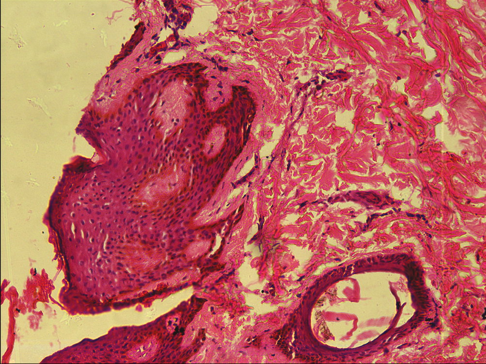 A ductule lined by cubical cells in association with epithelial strands, suggesting eccrine differentiation (H&E ×100)