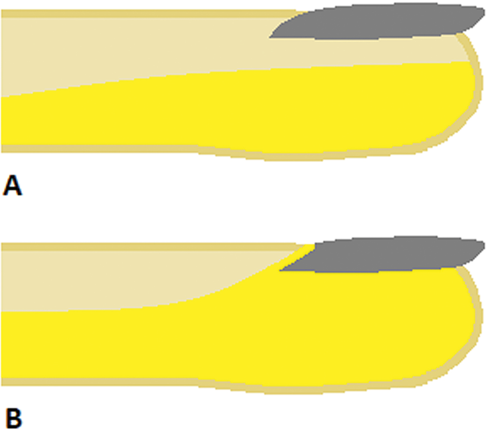 Innervation of the nail apparatus. (A) The thumb and fifth finger are innervated mainly by the dorsal proper digital nerve. (B ) The remaining fingers are innervated mainly by the volar proper digital nerves