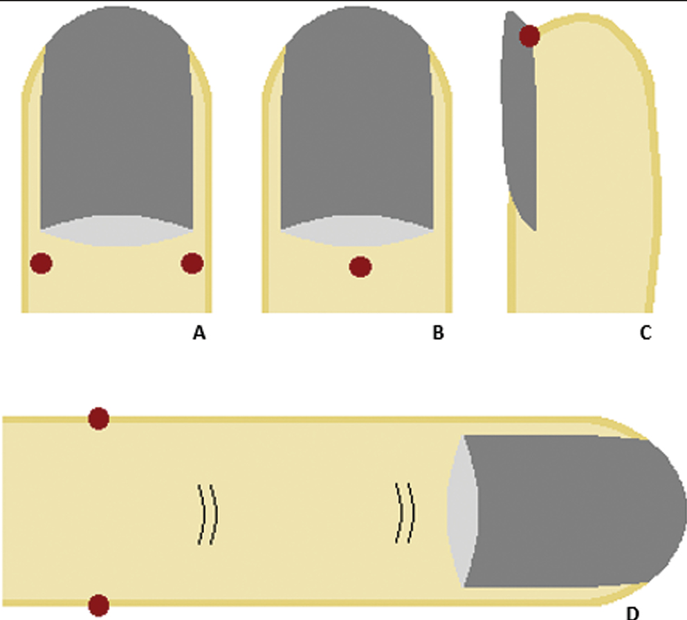 Anesthesia of the nail apparatus. (A) Distal digital block. (B) Distal anesthesia through the proximal nail fold. (C) Distal anesthesia through the hyponychium. (D) Traditional digital anesthesia