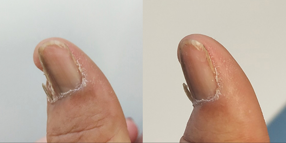 Nail dystrophy after incomplete removal of the lateral matrix horn. A separated lamina of nail plate is observed laterally and separated from the main one, originating from one lateral matrix horn, which was not completely removed during previous matricectomy