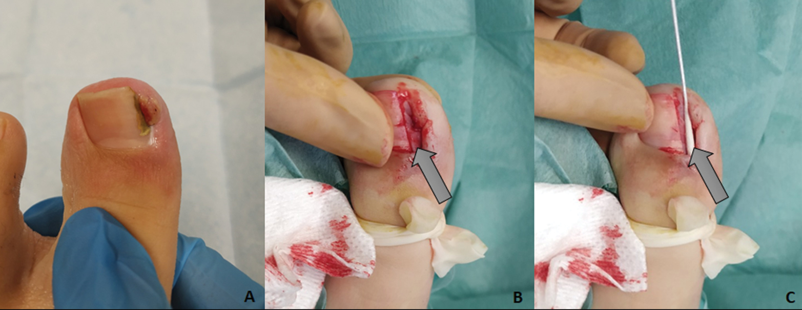 Segmental phenolization: (A) Ingrown nail before surgery, (B) unilateral 3-mm longitudinal avulsion of the nail plate, and (C) phenol application