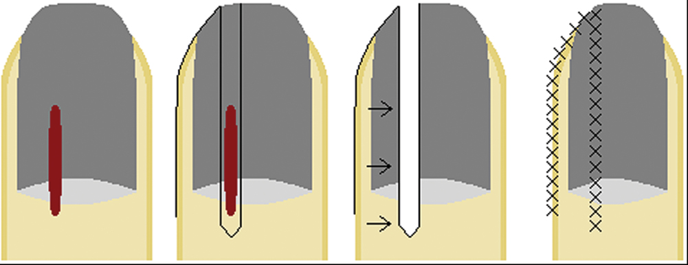 Schernberg flap: (A) paramedian longitudinal lesion involving all sections of the nail unit; (B) flap design, (C) flap is cut and advanced into the defect, and (D) flap sutured in place