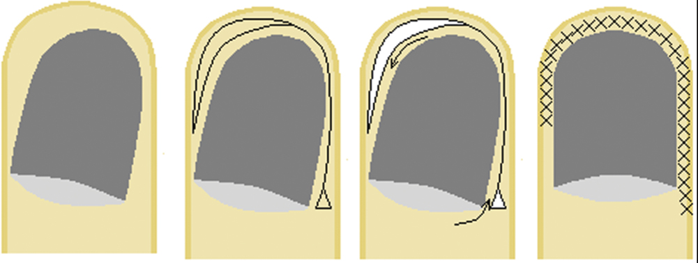 Unguodermal flap: (A) congenital malalignment of the great toenail, (B) flap design, (C) flap is cut and rotated into a normal orientation (as the nail unit is very firmly attached to the base of the distal phalangeal bone, dissection must be performed in this plan in order to enable rotation of the nail apparatus), and (D) flap sutured in place