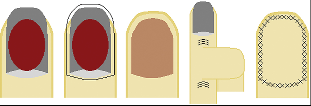 Cross finger flap: (A) large lesion occupying most of the nail unit, (B and C) the entire nail apparatus is removed, (C) flap is cut as a “U” from an adjacent digit, and (D) flap sutured in place