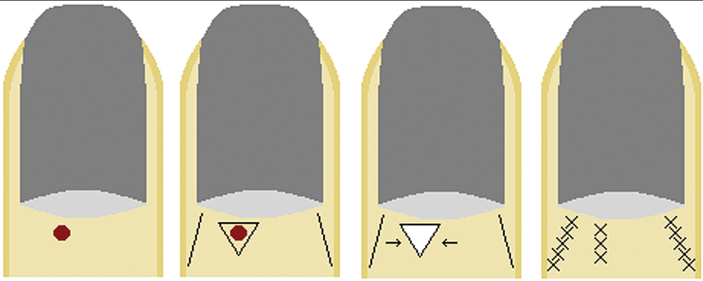 Bilateral advancement flap: (A) lesion on the proximal nail fold, (B) flap design, (C) flap is cut and advanced into the defect, (D) flap sutured in place (if the secondary defects cannot be closed directly, they are left to heal by secondary intention)