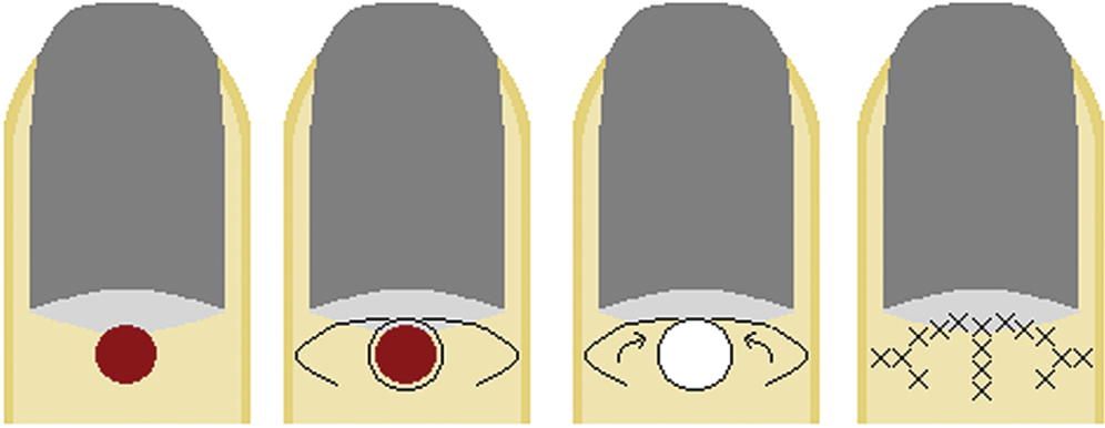 V–Y rotation advancement flap: (A) large lesion on the proximal nail fold, (B) flap design, (C) flap is cut, rotated, and advanced into the defect, and (D) flap sutured in place