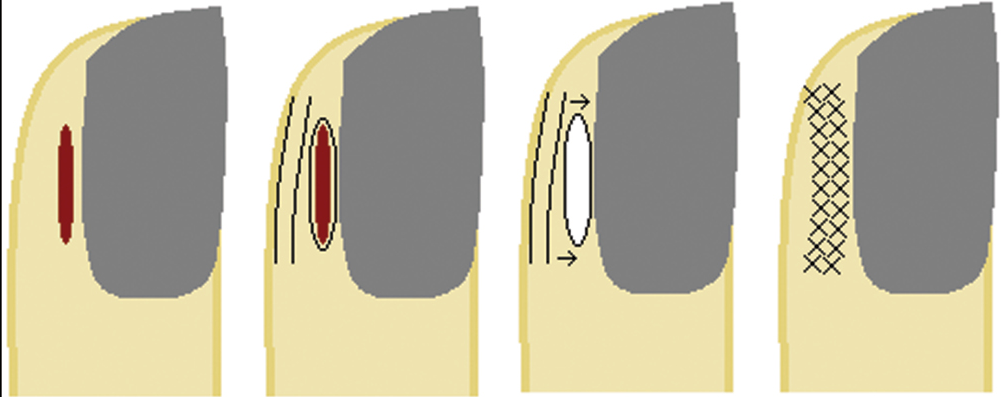 Bipedicle lateral nail fold flap: (A) lesion on the lateral nail fold, (B) flap design, (C) flap is cut and advanced into the defect, retaining its proximal and distal attachments, and (D) flap sutured in place