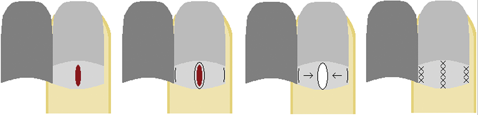 Matrix bipedicle flap: (A) midline lesion arising from the nail matrix, (B) flap design, (C) flap is cut and advanced into the defect, retaining its proximal and distal attachments, and (D) flap sutured in place