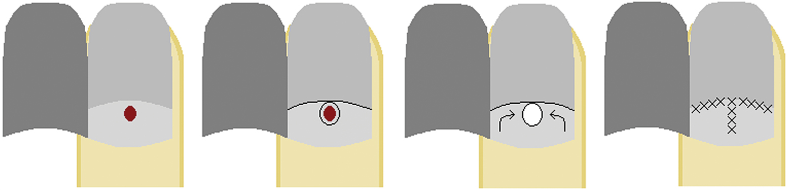 Bilateral sliding (advancement and rotation) flap: (A) lesion arising from the mid to distal nail matrix, (B) flap design, (C) flap is cut, rotated, and advanced into the defect, and (D) flap sutured in place