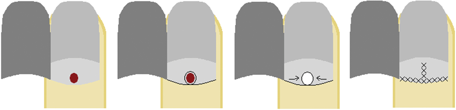 Bilateral A-to-T advancement flap: (A) lesion arising from the proximal nail matrix, (B) flap design, (C) flap is cut, rotated, and advanced into the defect, and (D) flap sutured in place