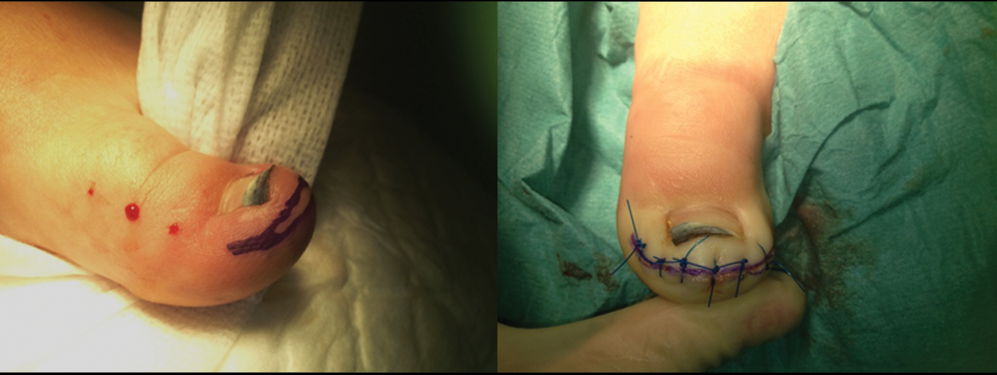 Performance of a fish-mouth incision parallel to the distal groove on the tip of the toe, such that its closure pulls the distal nail wall down