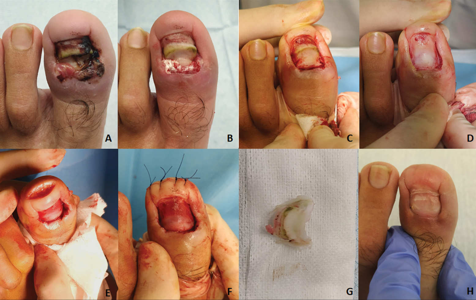 Retronychia: (A) initial appearance, (B) appearance of the nail apparatus after removal of the first nail plate, (C) appearance of the nail apparatus after removal of another nail plate and curettage of granulation tissue, (D) nail plate avulsion complete, (E) plasty of the digital pulp using Howard Dubois technique, (F) result by the end of the surgery, (G) image of some of the nail plates removed, and (H) follow-up six months later, with satisfying cosmetic and functional results