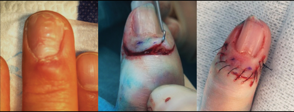 Digital myxoid pseudocyst. Simple excision with ligation of the pedicle in the distal interphalangeal joint