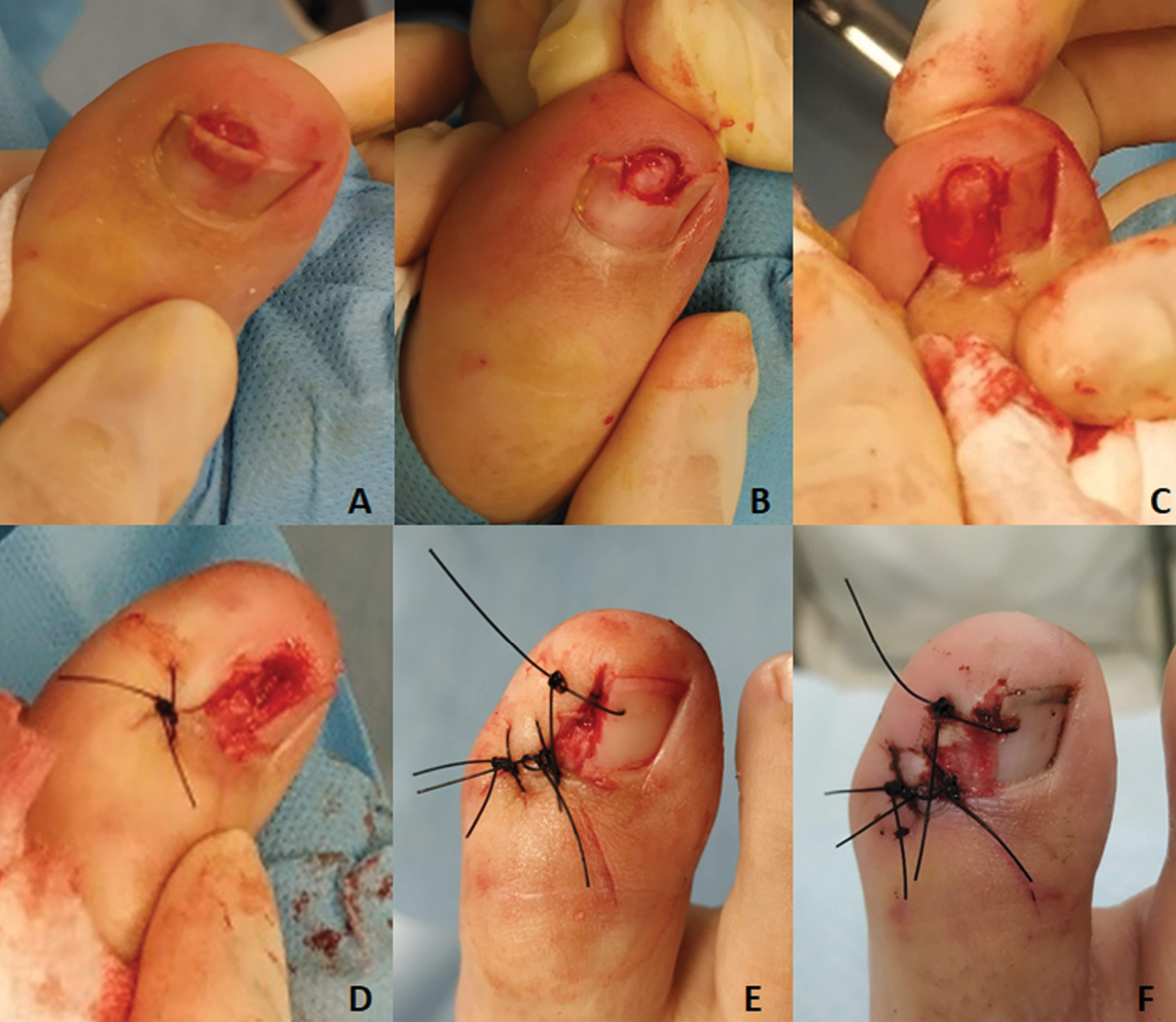 Subungual exostoses. (A) A lesion is observed under the distal nail plate; B: bone consistency is perceived after removing part of the nail plate. (C and D) Overlying skin is incised and the exostosis is dissected and clipped off at its base. (E) Result by the end of the surgery. (F) Result two weeks after surgery