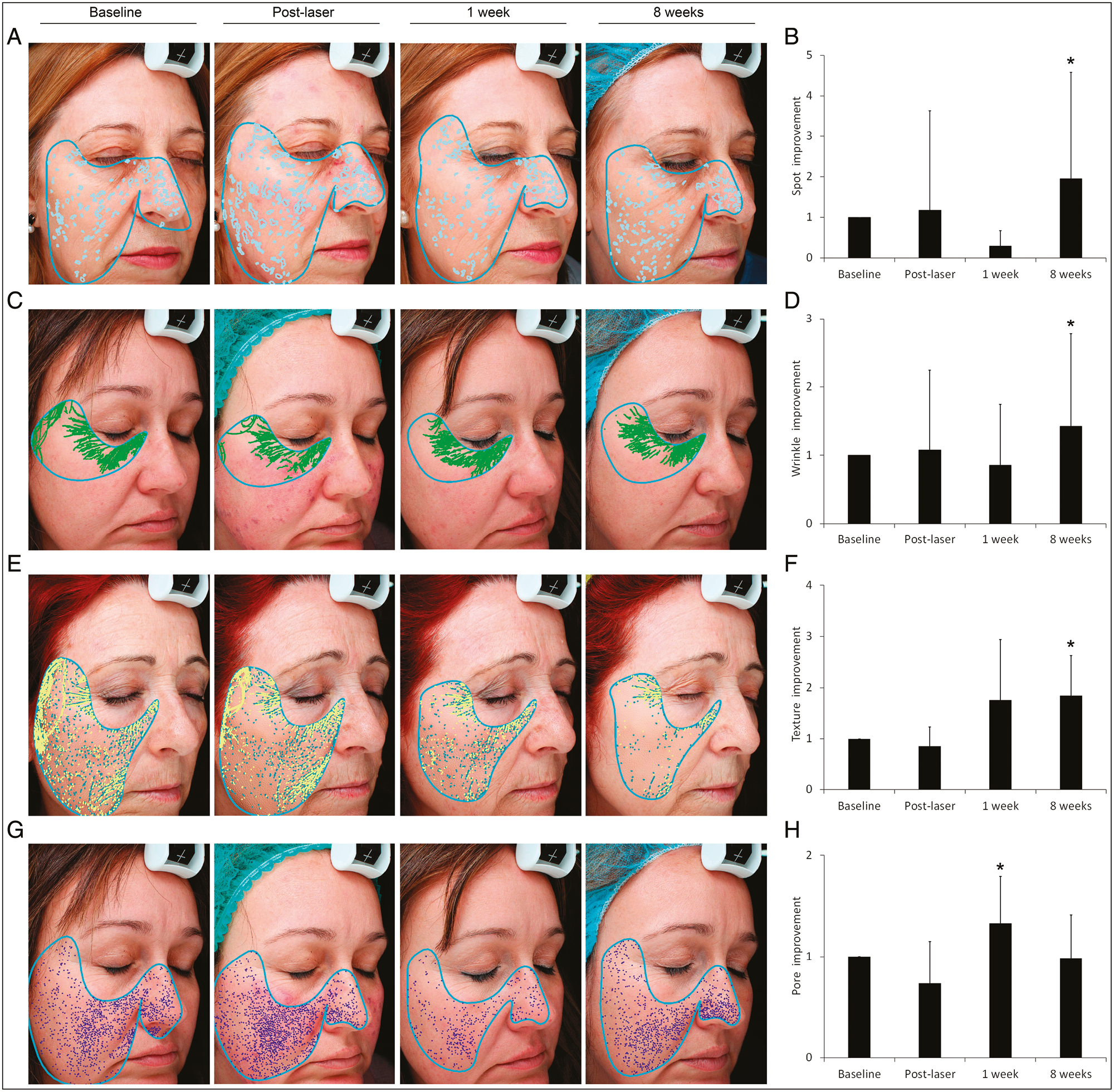 Skin complexion analysis using the VISIA-CR System. (A and B) Combined treatment showed to improve spot percentile after 8 weeks. (C and D) Wrinkle reduction was noticeable at 8 weeks. (E and F) Texture improvement achieved the statistical significance after 8 weeks. (G and H) Pore index decreased 1 week after treatment. *Statistically significant differences compared to baseline (*P ≤ 0.05)