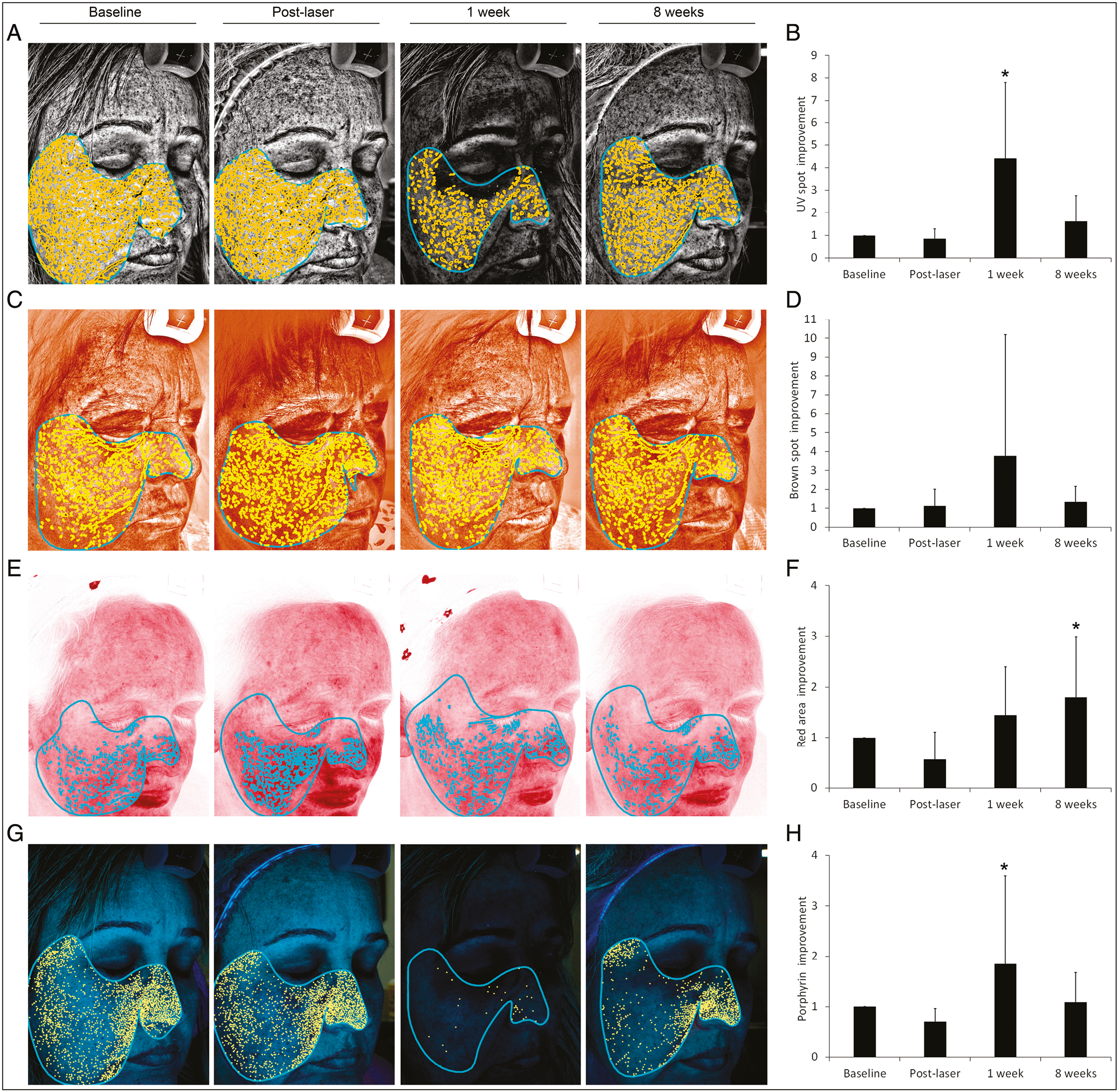 Skin complexion analysis using the VISIA-CR System. (A and B) Combined treatment showed to improve UV spot percentile after 1 week. (C and D) Although brown spots showed a slight improvement after 1 week, the statistical significance was not reached. (E and F) Red area improvement achieved the statistical significance after 8 weeks. (G and H) Porphyrin index decreased 1 week after treatment. *Statistically significant differences compared to baseline (*P ≤ 0.05)