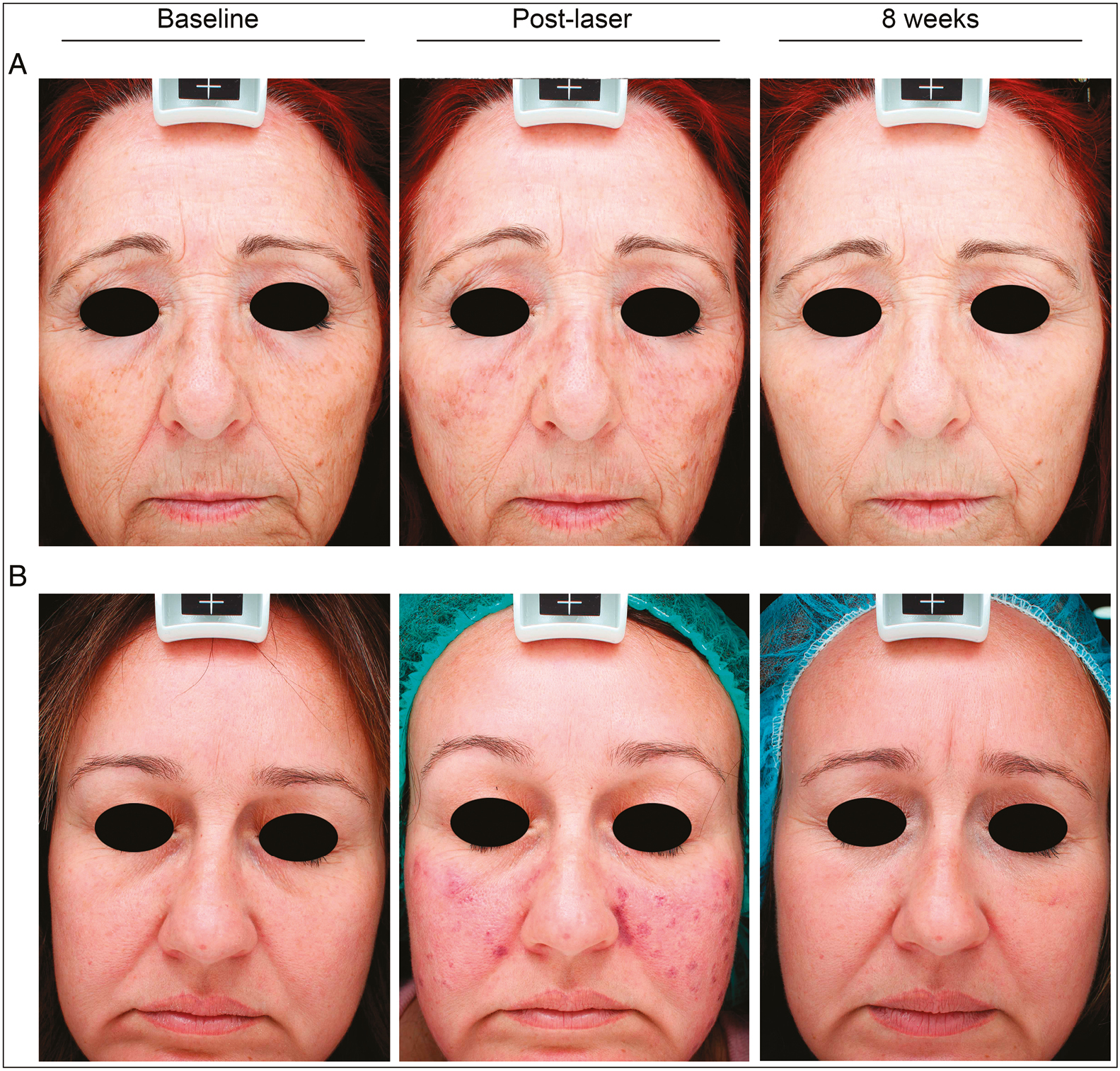 Standardized facial photographs of patients during the study at baseline, just after the laser treatment and at the end of the follow-up period