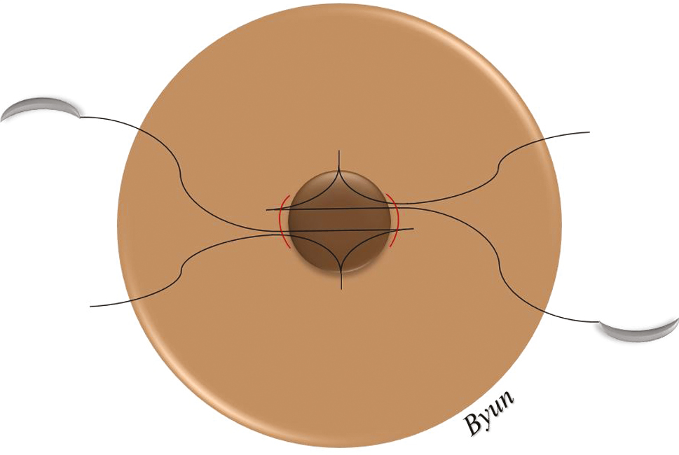 Schematic drawing of the double triangle suture technique for inverted nipple correction