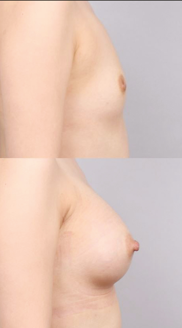 Preoperative (above) and postoperative (below) 1-year views of a 24-year-old female who received inverted nipple correction with augmentation mammoplasty