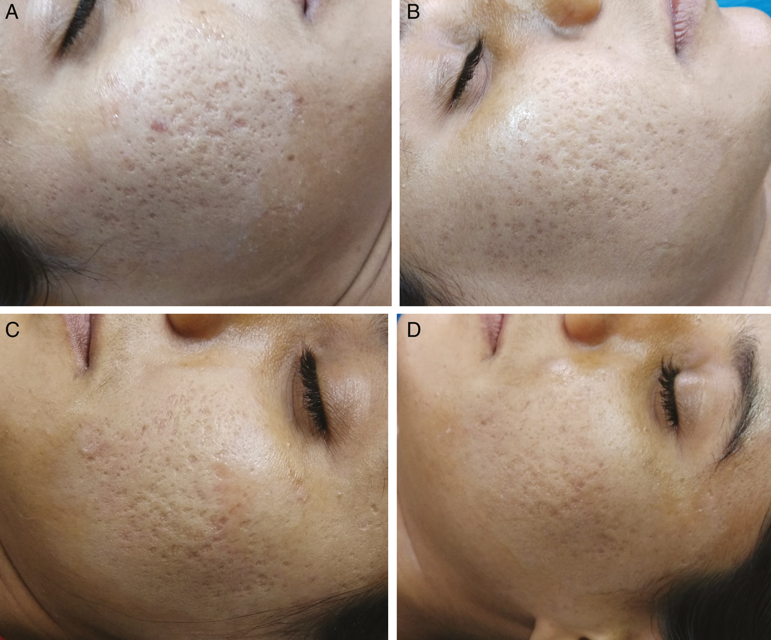 24-year-old female right side of face (A & B), treated with PRP injections & left side of face (C & D), treated with NS injections. A: Pre-treatment photograph before first treatment session, showing multiple scars of all the three types with G&B grade 4. B: Post-treatment photograph 1 month after the last treatment session, showing remarkable improvement of 60–80% and shift to G&B grade 3. C: Pre-treatment photograph before first treatment session, showing multiple scars of all the three types with G&B grade 4. D: Post-treatment photograph 1 month after the last treatment session, showing remarkable improvement of 60–80% and shift to G&B grade 3