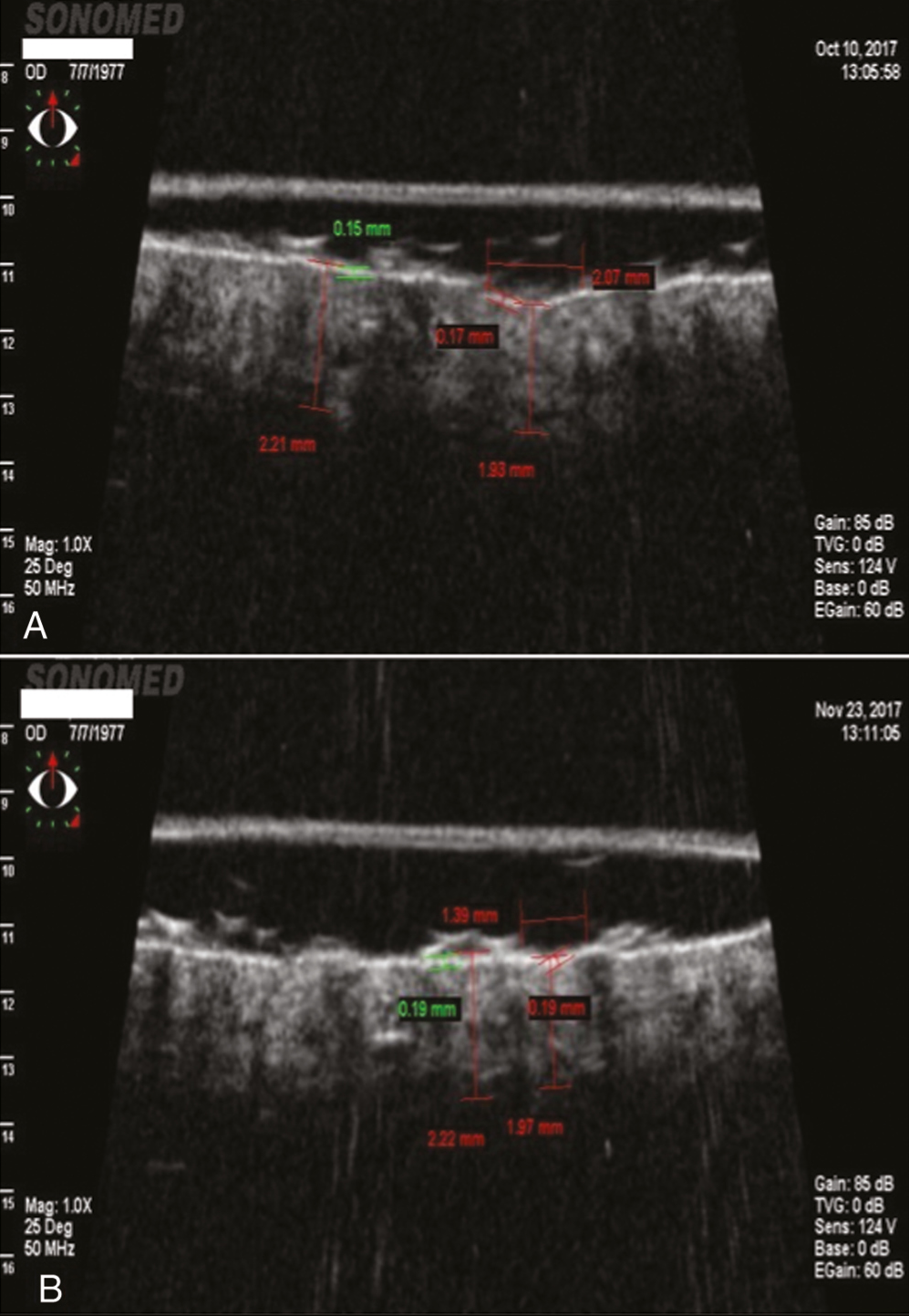 Pre & Post treatment photographs of UBM analysis of acne scar. A: Pre-treatment photograph before first treatment session, showing a scar of 2.07 mm diameter and 1.93 mm in thickness. B: Post-treatment photograph of the same scar 1 month after the last treatment session, showing reduction in diameter of the scar to 1.39 mm and increased thickness of 1.97 mm