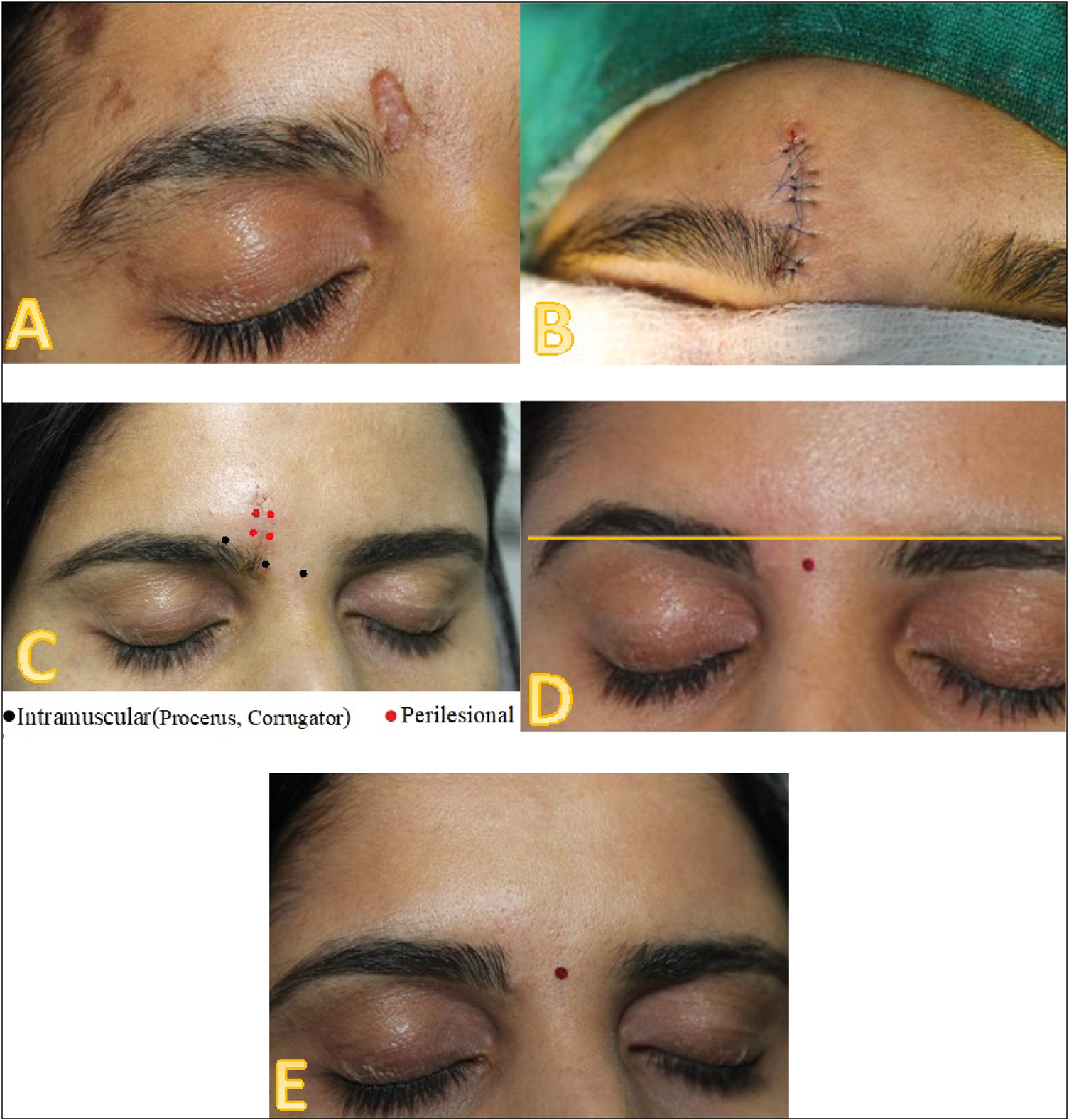 (A) Patient in group A with a scar over right medical eyebrow—pre-surgical. (B) Immediate post-surgery. (C) At the time of suture removal and injection of BTX. (D) Raised eyebrow following BTX injection. (E) Post-1-year follow-up