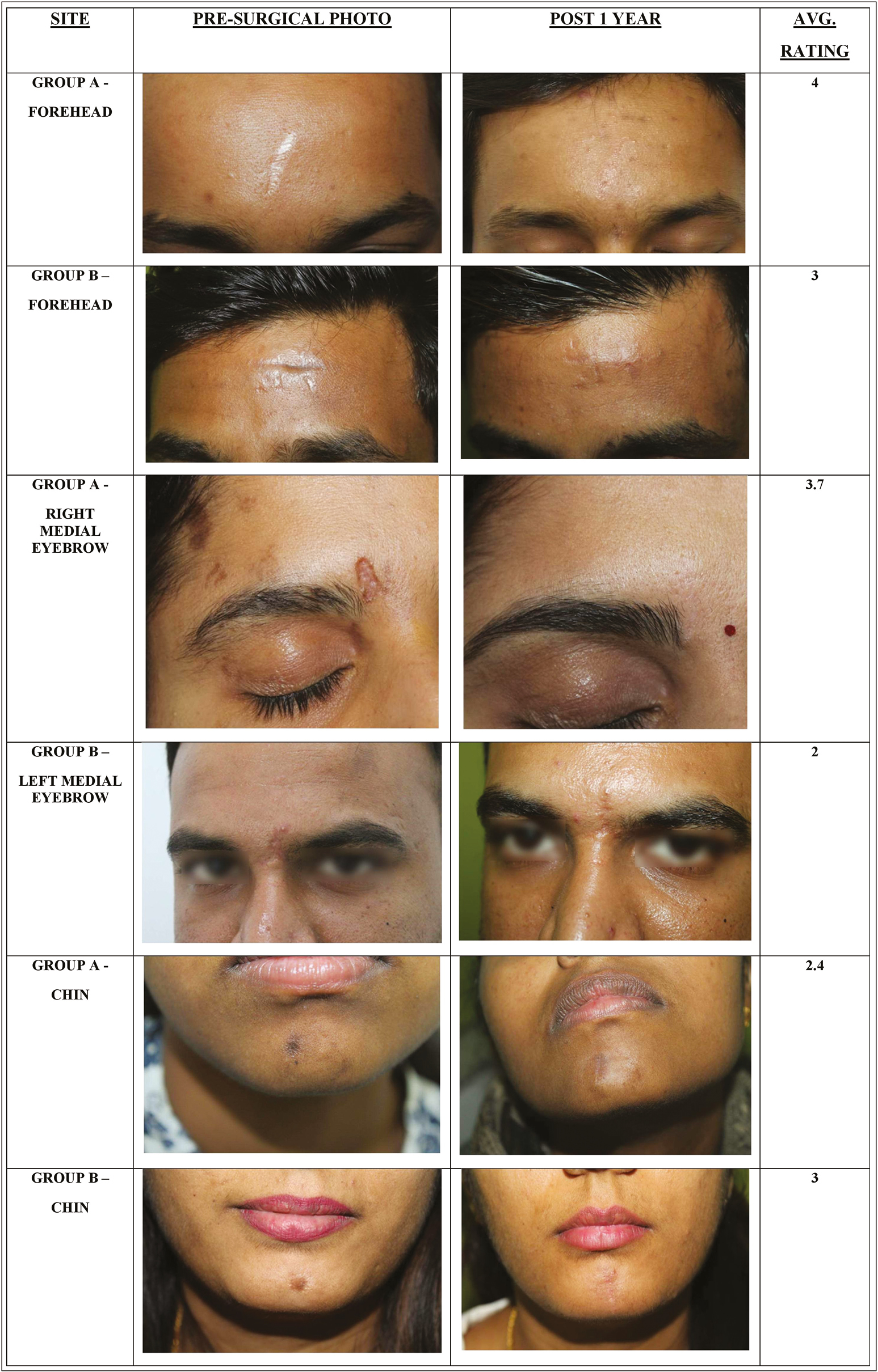 Pre- and post-surgical photos of three site-matched scars in group A and group B and their average rating