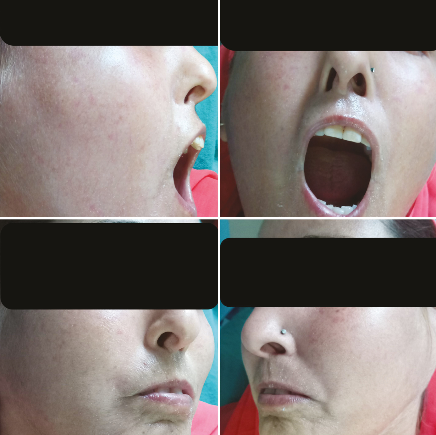 Improvement in mouth opening and interincisor distance after three sessions