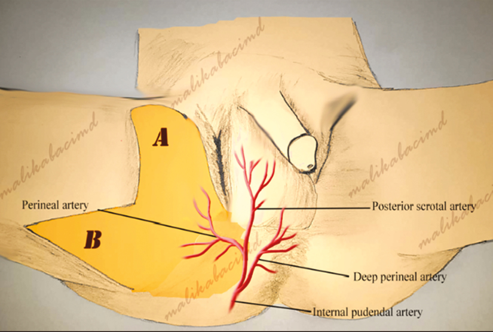 Gradual recovery in the first year of the reconstruction process. A, Debridement procedure after fasciitis. B, Defect was totally reconstructed using a bilobed pudendal flap obtained from the right medial thigh. C, Scrotal skin has been observed to magnificently match and function 1 year after reconstruction