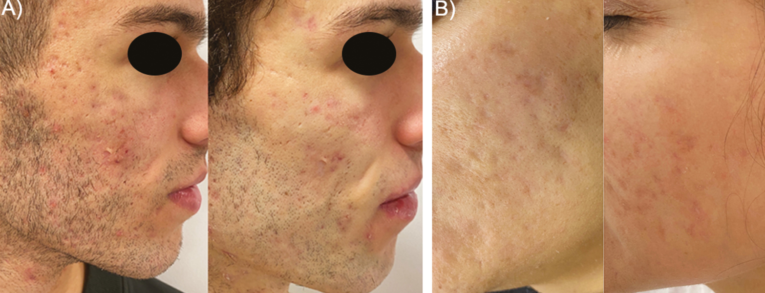 Representative macrophotographs of two patients (A, B) suffering from post-acne scars. Before (left) and after combined therapy situations (right) show a noticeable clinical improvement of the skin quality and overall scar amelioration