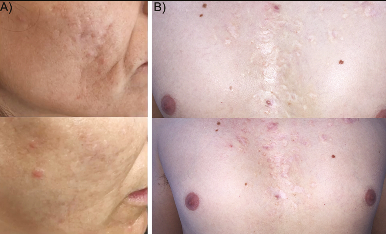 Representative macrophotographs of two patients (A, B) suffering from post-acne scars. Before (up) and after combined therapy situations (down) show a noticeable clinical improvement of the skin quality and overall scar amelioration