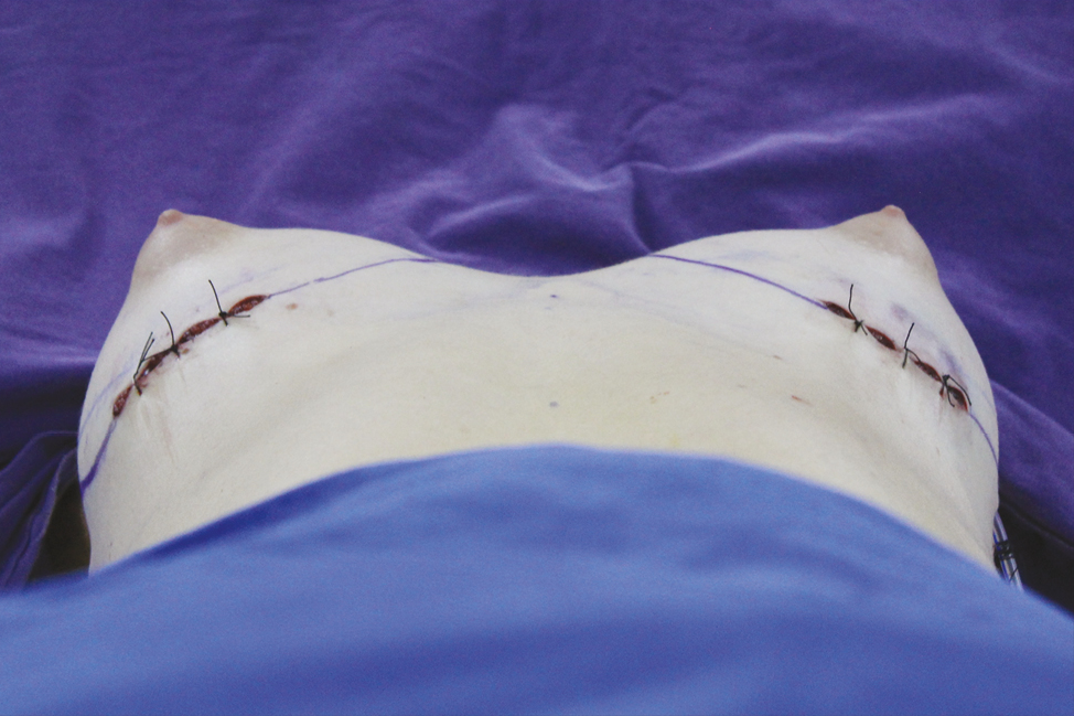 After the inframamarian incisional approach for augmentation mammoplasty, the areolar protrusion becomes prominent with placement of the prostheses. It is best observed from the lateral and basal viewpoints