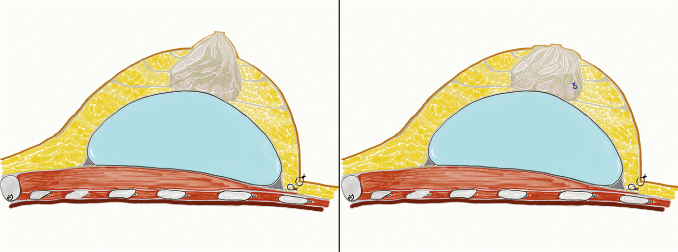 As can be seen in the schematized version of the increased areolar bump, the glandular structure becomes more protruberant with the effect of the underlying prosthesis (top). Surgical approach is with an incision made on the fascia on the posterior wall of the gland, close to the lower border projection of the areola. In order to decrease the height of the areola, a partial glandular tissue resection is performed, which should match the width and height of the areola (below).