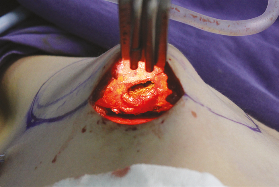 The surgical approach to the posterior glandular area following inframamarian incision is shown. A perioperative view, just before fascial repair and after resection from the area opened by a horizontal incision to the fascia