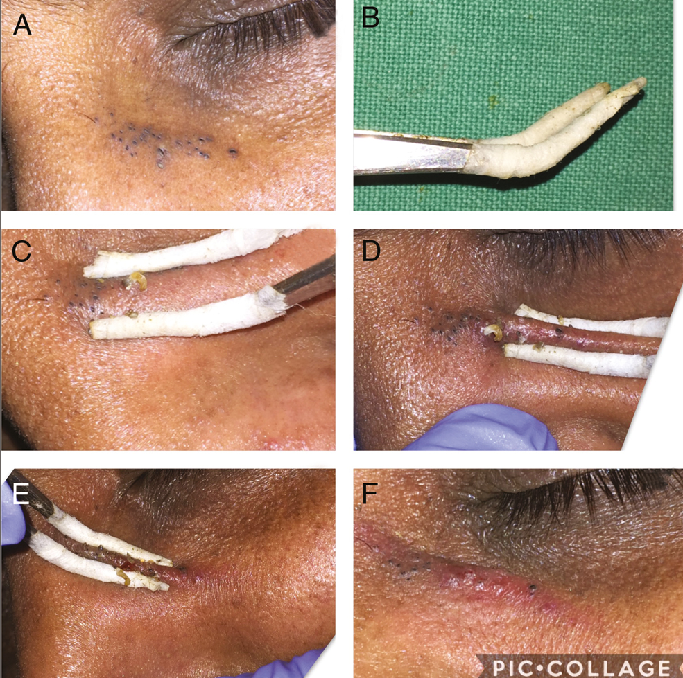 (A) The senile comedone over loose, thin infra-orbital region. (B–E) The senile comedone is extracted out with a tissue forceps wrapped with micropore adhesive tape. (F) The extracted senile comedone lesions