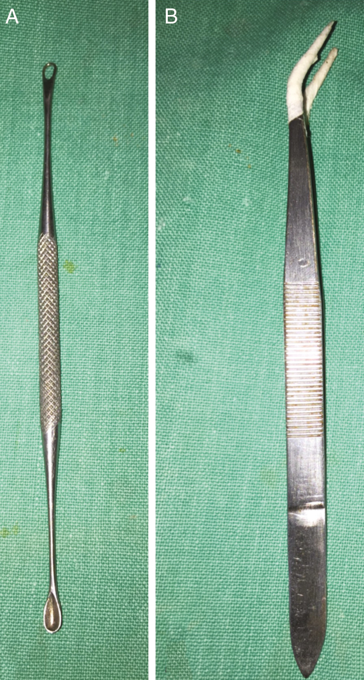 Conventional comedone extractor (A) and micropore wrapped forceps (B) for periorbital region and eyelid for comedone extraction