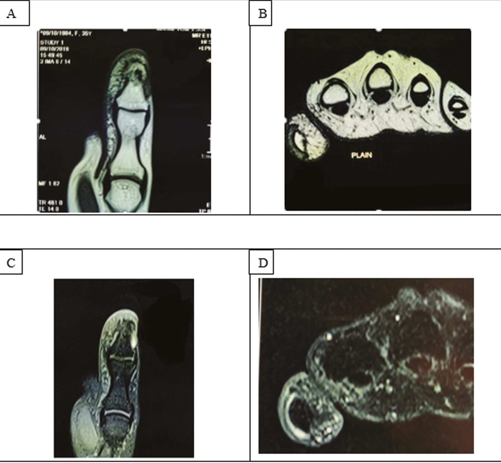 MRI of the right thumb. A. T1 coronal for thumb. B. T1 axial. C. Post-contrast T1 fat saturated coronal image of the thumb. D. Post-contrast T1 fat saturated axial image of the thumb. MRI showed a focal soft tissue nodular thickening at subungual aspect of the thumb. On T1, the lesion was isointense to muscle. On post contrast, this lesion showed avid enhancement. Underlying bone was normal. Findings were suggestive of a benign hypervascular lesion