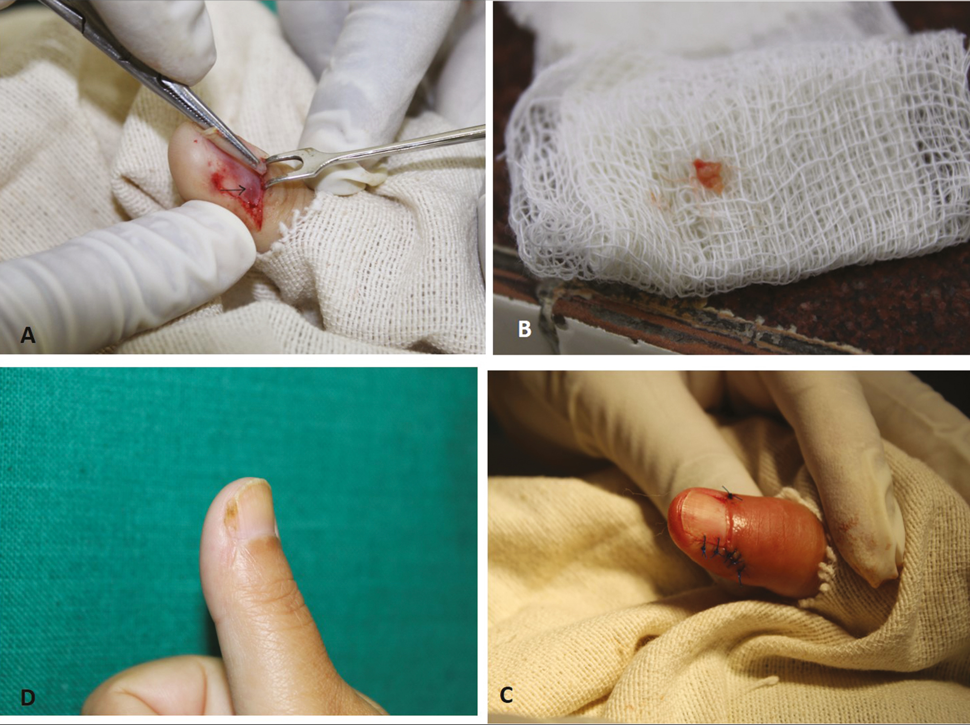 A. Trans-ungual approach to the tumor (black arrow) with exposure of nail bed and matrix after reflecting the nail plate and proximal nail fold. B. Excised tumor tissue. C. The nail plate and proximal nail fold re-positioned with the help of 4-0 non-absorbable sutures. D. Asymptomatic with well healed scar 3 months post-operatively