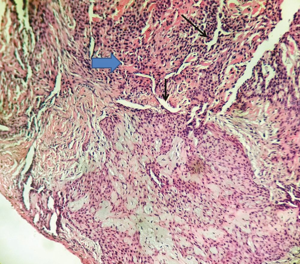 Photomicrograph of the excised lesion showing varying sized vessels (black arrows) surrounded by collarettes of glomus cells (blue arrow) (H&E, ×10)