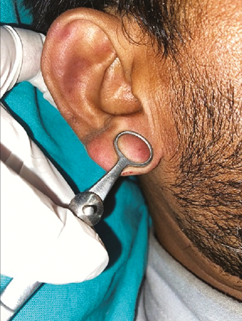 Use of chalazion clamp in slit skin smear sampling in ear lobule