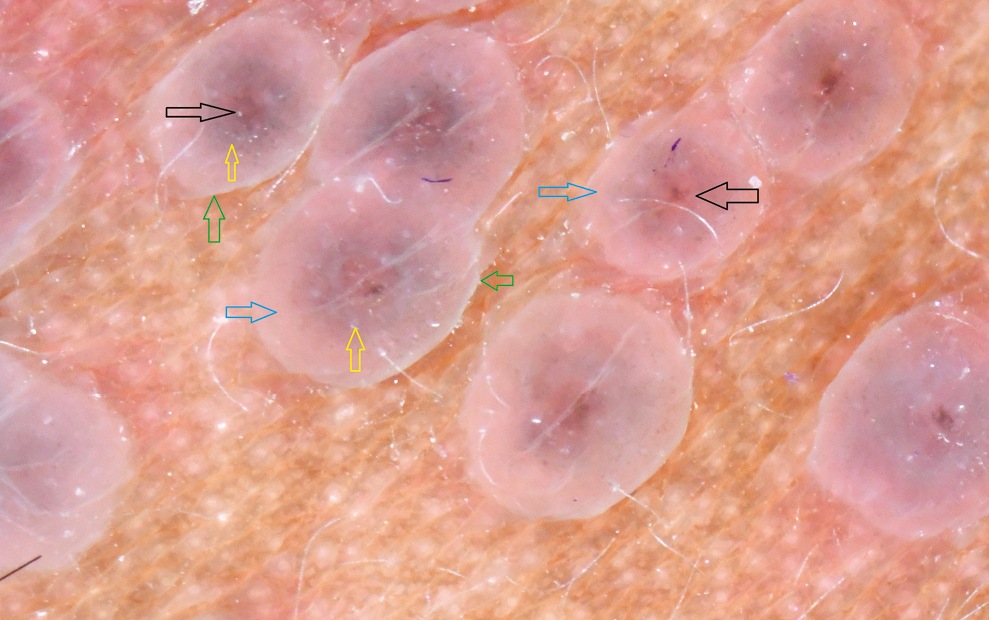 Dermoscopy of early lesions of herpes zoster shows polylobular structures with central brown globules (black arrows), gray zone (yellow arrows), pale pink area (blue arrows), and grayish rim (green arrows). (DermLite Foto II Pro Plus, 10× magnification, polarized)