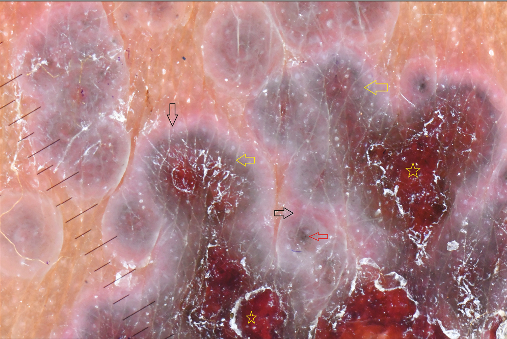 Dermoscopy of matured lesions of herpes zoster shows dark red areas (yellow stars), darker gray area (yellow arrows), and pale pink area in the periphery (black arrows). Note the gray dots in the center of lobule (red arrow). (DermLite Foto II Pro Plus, 10× magnification, polarized)