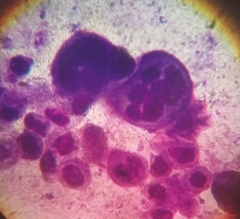 Tzanck smear from the base of the vesicles showing multinucleated syncytial giant cells and acantholytic cells. (Oil immersion, 100×)