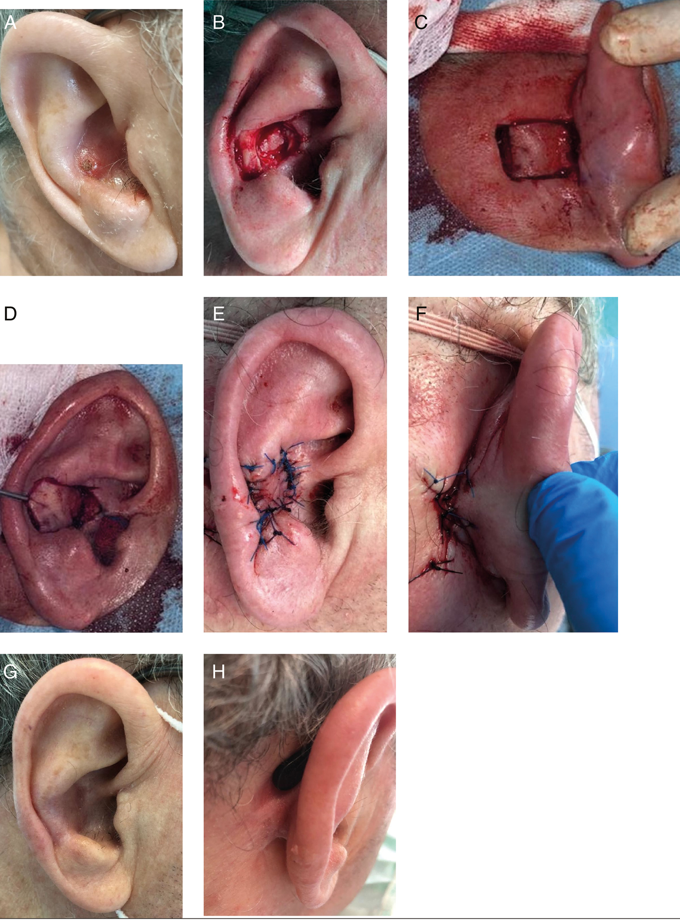 A: Squamous cell carcinoma of the right conchal bowl and antihelix. B: Defect of the right conchal bowl and antihelix measuring 2.4 × 1.7 cm. C: Flap donor site was marked and peripherally excised, preserving a subcutaneous pedicle that originated from the postauricular sulcus. D: The flap was then pulled through a tunnel and adapted to the defect, without tension, torsion, or impingement of the pedicle. E: The flap was sutured into place. F: The secondary defect was easily closed primarily. G: Nine months after surgery, an excellent cosmetic outcome was observed (lateral view). H: Nine months after surgery, an excellent cosmetic outcome was observed (posterior view)