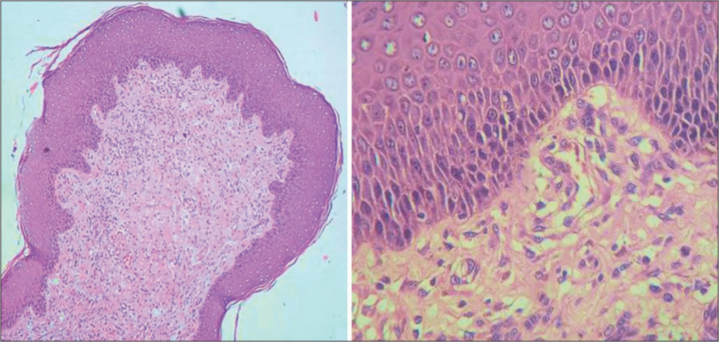 (H and E) staining revealed basket weave hyperkeratosis with acanthotic epidermis. In dermis alternative hypo/hypercellular areas with myxoid matrix, fibrous ground substance, cystically dilated blood vessels (H and E, ×10—left, ×40—right) H &E: Hematoxylin–eosin.