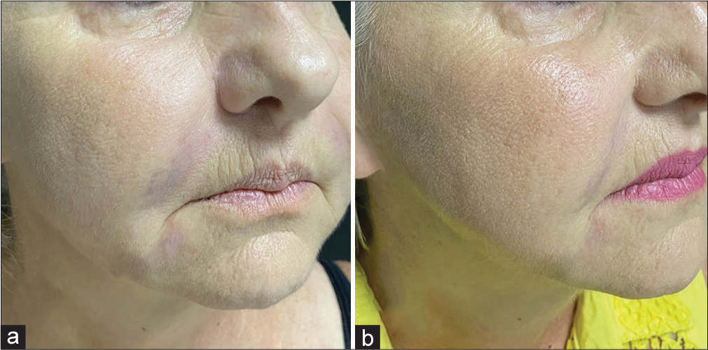 Induced degradation of a temporary filler in a female patient (61-year-old). (a) Formation of nodules and hardened areas in the nasolabial folds, mouth commissure, and mandibular contour after the application of hyaluronic acid on the face a week ago. (b) Two days after application of hyaluronidase in compromised areas: Complete resolution of the nodules and the overcorrection.