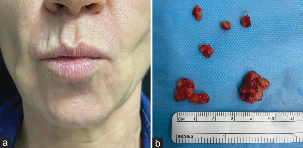 Female patient, 53-year-old. Polymethylmethacrylate was injected 12 years ago in the face. (a) Foreign body granulomas on the face. (b) Macroscopic specimen removed after intralesional laser treatment.