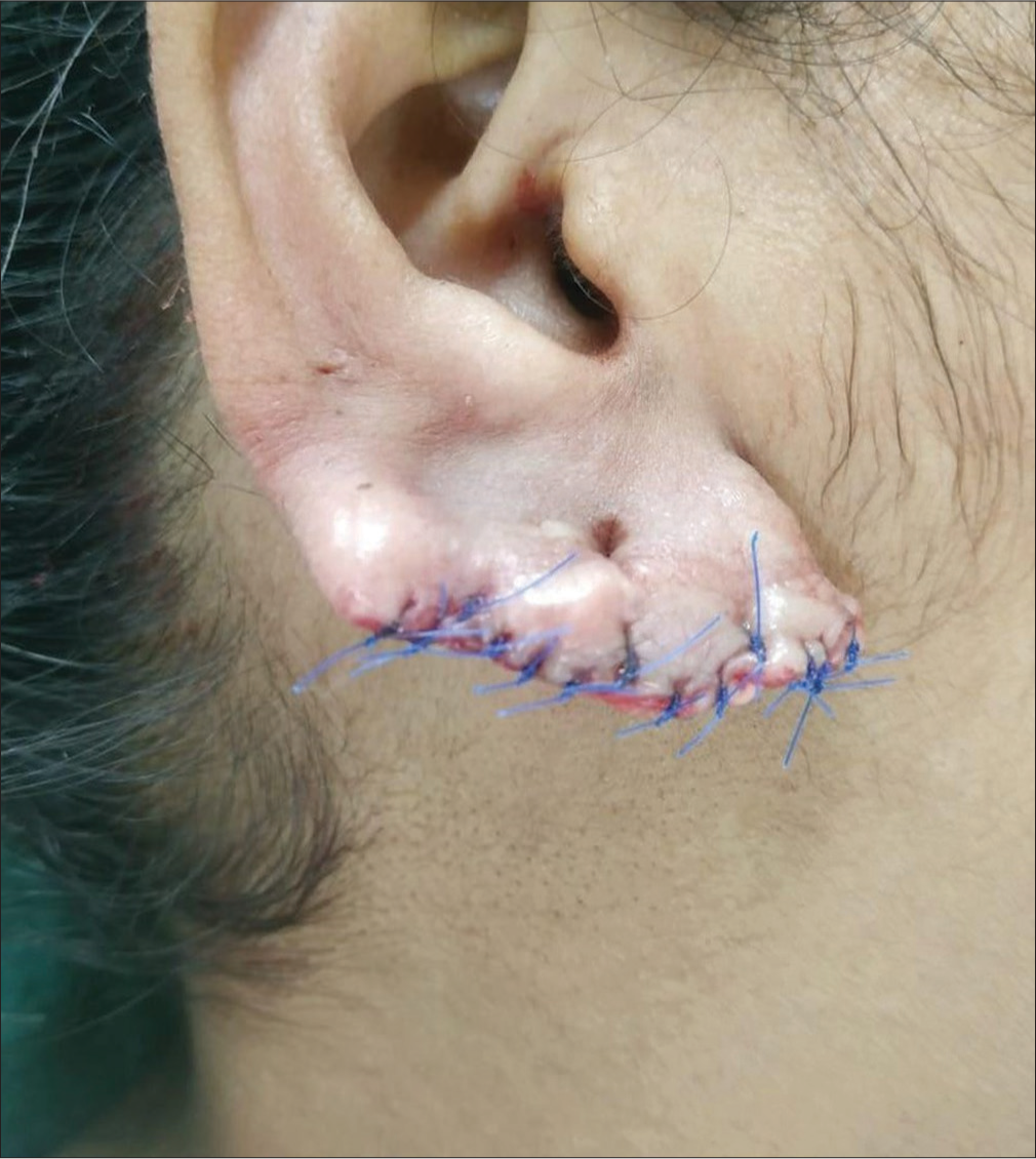 Sutured earlobe defect.