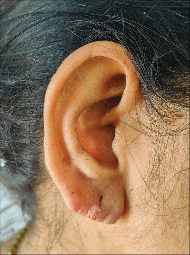 Complete resolution without recurrence of earlobe keloid after 6 months.