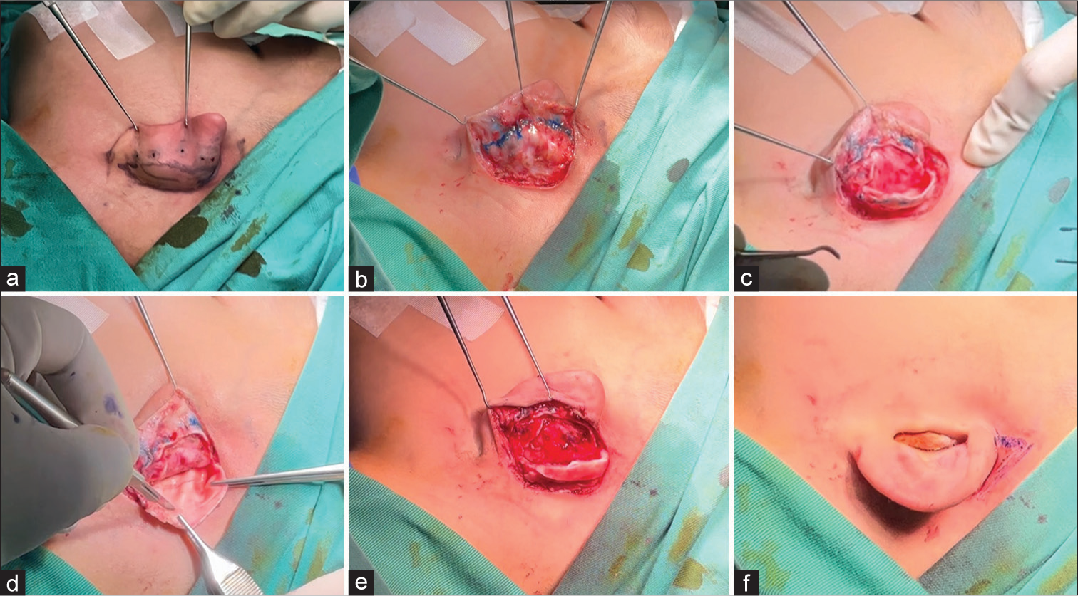 Otoplasty techniques: (a) Ear was folded back to form antihelical fold and the height of antihelical fold was tattooed with Bonney’s blue using a needle. An elliptical post-auricular skin incision was designed. (b) Perichondrium with the previous tattoo marking visualized. (c) Full thickness cartilage incision made along the scapha, preserving at least 6 mm of helical rim to maintain structural integrity. Anterior surface of cartilage was degloved of its skin and perichondrium. (d) Multiple superficial curved scores were made in the cartilage along the proposed antihelix to break the outer layer of cartilage. (e) The cartilage folded by virtue of these parallel but superiority diverging cuts, thus forming a new antihelical fold. The neohelix was sutured to the mastoid fascia using Monosyn 6/0 (mastoid hitch) as means to maintain helical elevation and prevent recurrence. (f) An inverted triangular incision was made at the supra-auricular region, which was in continuity with the superior edge of the postauricular incision. Approximation between the two created an increased vertical height and correction of helical lidding.